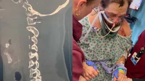 Ohio Man Survives Internal Decapitation After Tree Falls on Him at Work