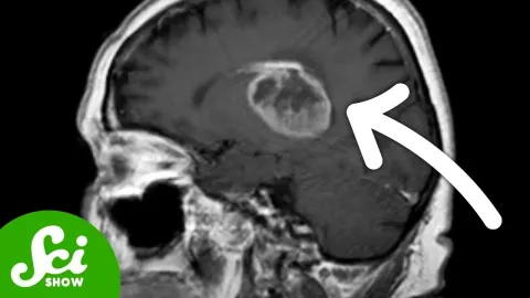 Turning Glioblastoma Cells into Functional Neurons