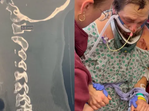 Ohio Man Survives Internal Decapitation After Tree Falls on Him at Work