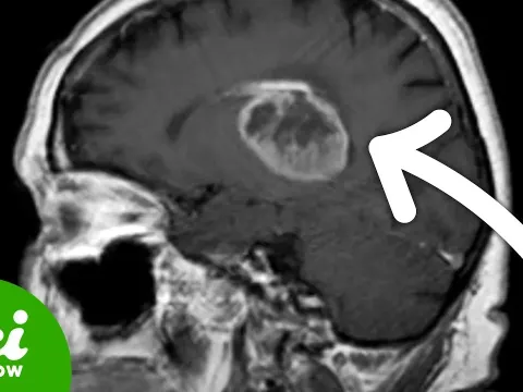 Turning Glioblastoma Cells into Functional Neurons